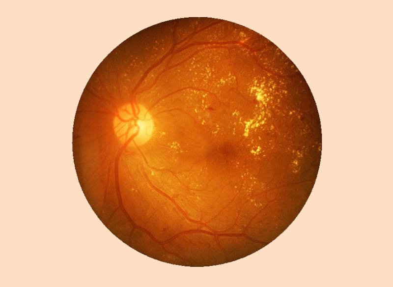 Діабетична ретинопатія - Закарпатський центр зору та Закарпатський центр мікрохірургії ока