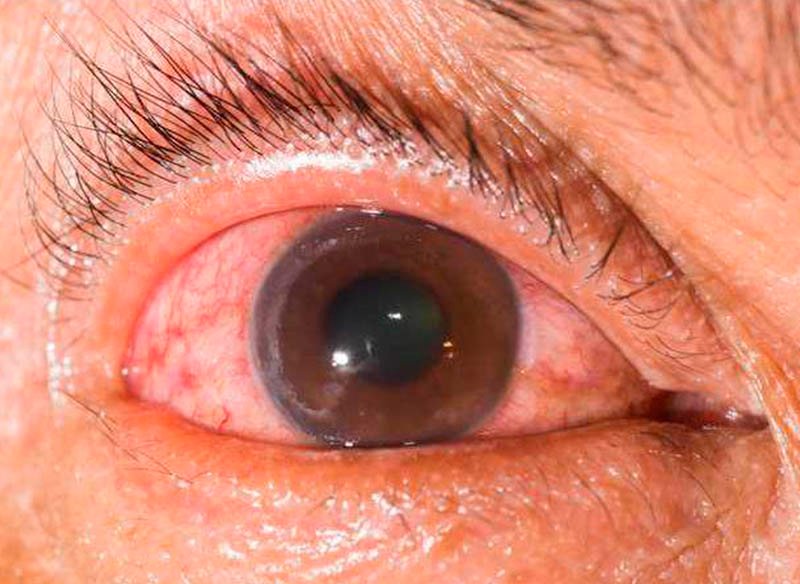Глаукома - Закарпатський центр зору та Закарпатський центр мікрохірургії ока