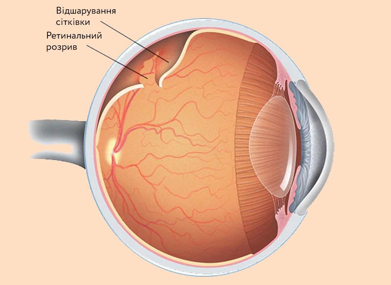 Відшарування сітківки - Закарпатський центр зору та Закарпатський центр мікрохірургії ока