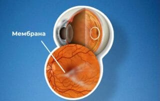 Нечітке сприйняття контурів предметів — ознака епіретинальної мембрани сітківки - Закарпатський центр зору та Закарпатський центр мікрохірургії ока